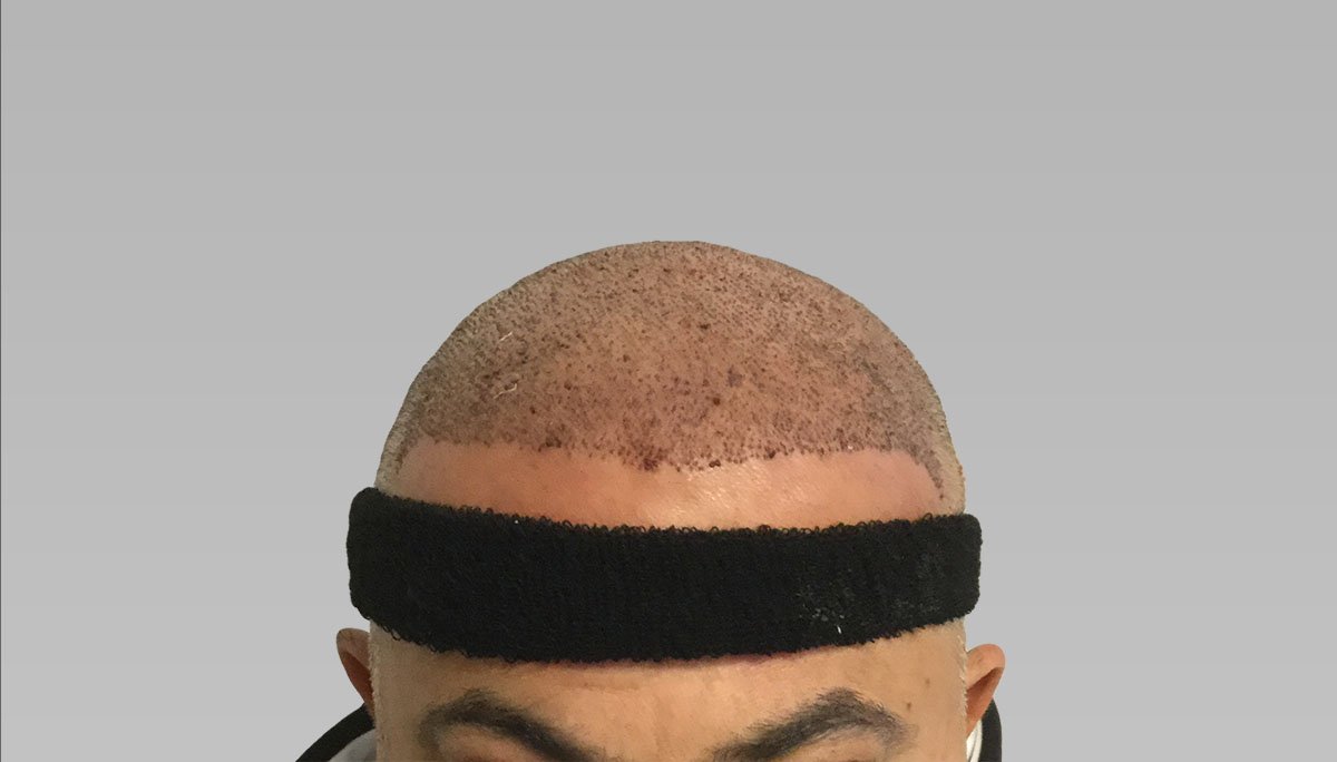 Hair Transplant